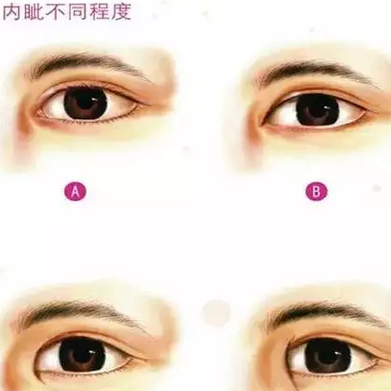 开眼角后留疤怎么办?|开眼角|疤痕|皮肤萎缩