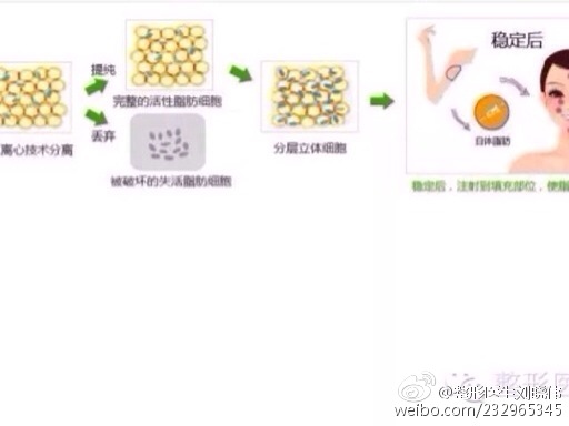 自体脂肪填充----------变废为宝的身体革命！