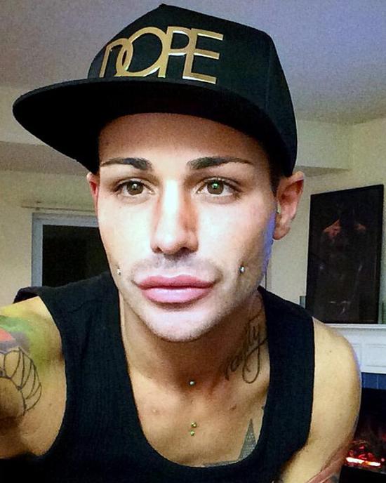 美国男子花巨资整容百次 屁股植入硅胶变翘臀