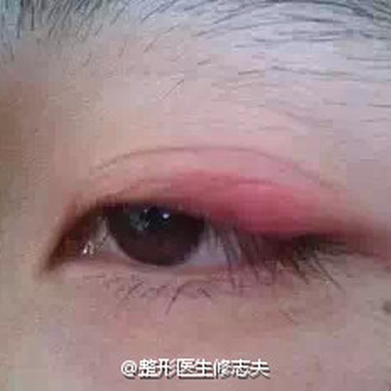 双眼皮贴还贴不贴?双眼皮贴的危害有哪些?