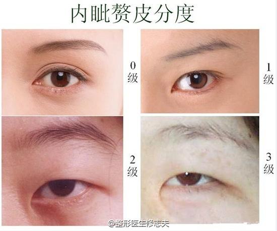 你的眼距理想吗?|内眦赘皮|眼睛|内眼角_新浪女性_新浪网