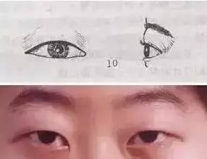 双眼皮