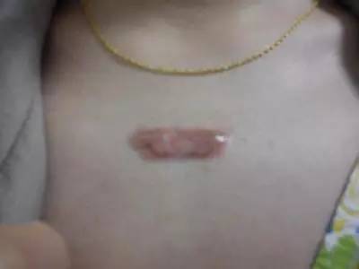 什么是疤痕体质,疤痕体质可以做整形吗?|疤痕|