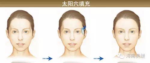 自体脂肪填充太阳穴,美丽与好运俱可兼得