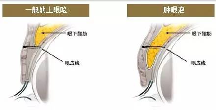 埋线双眼皮