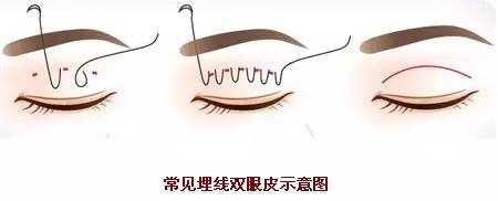 埋线双眼皮