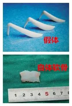 自体软骨隆鼻尖哪里的骨头最好?|软骨|隆鼻|鼻