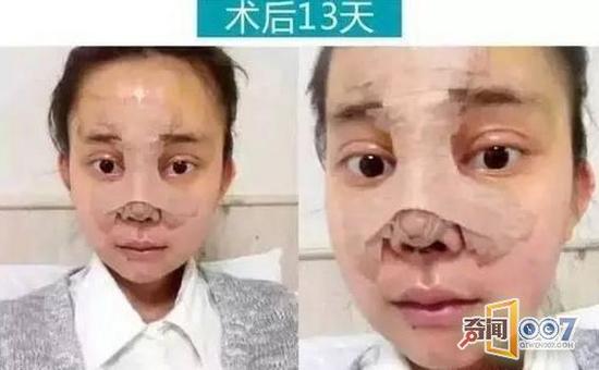 鼻综合手术和面部脂肪填充