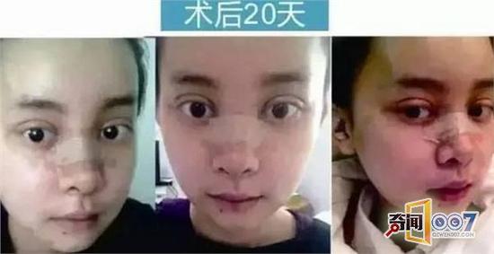 颌面手术后20天了
