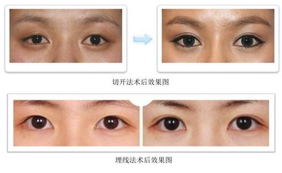 双眼皮整形手术,埋线还是切开?