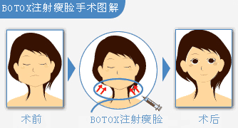 注射瘦脸针过程图