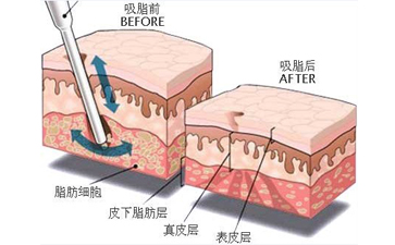 抽脂