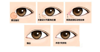 整形科普:双眼皮开眼角手术如何避免疤痕增生|疤痕|开眼角|双眼皮_新浪女性_新浪网