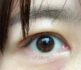 长期贴双眼皮贴会变成双眼皮吗?|双眼皮|双眼皮