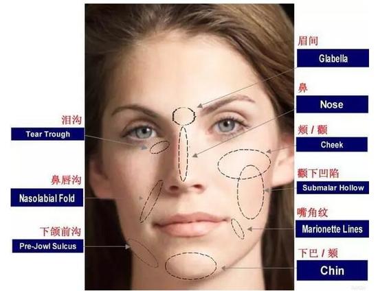 自体脂肪填充打造最美心形脸|自体脂肪|面部