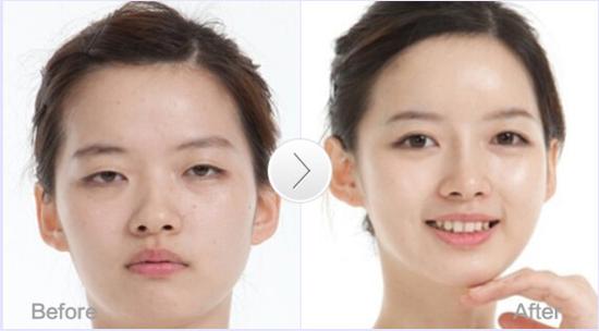 开眼角术后常出现的问题及如何避免?|开眼角|护理|避免_新浪女性_新浪网