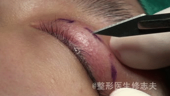 小切口法双眼皮手术过程