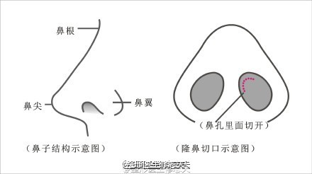 单纯隆鼻切口示意图单纯隆鼻切口示意图