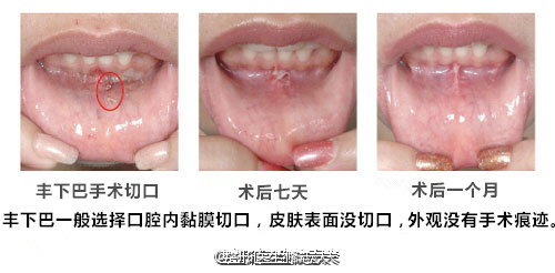 丰下巴切口恢复过程丰下巴切口恢复过程