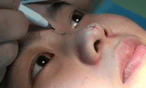 隆鼻手术过程隆鼻手术过程