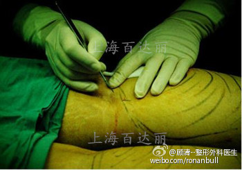 小腿吸脂术与瘦腿针的比较|小腿|脂肪|瘦腿