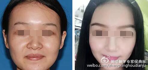 瘦脸针效果