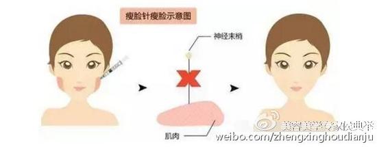 瘦脸针示意图