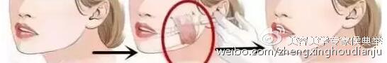 瘦脸针