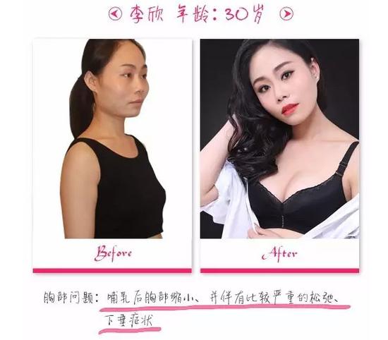 针对产后乳房松弛、下垂、萎缩等问题。