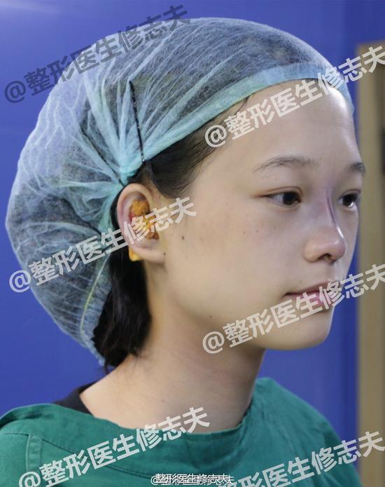 一个关于消灭塌鼻梁的故事|鼻梁|玻尿酸|鼻子