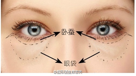卧蚕和眼袋图片 e3T1-fxxfyex5311468.jpg