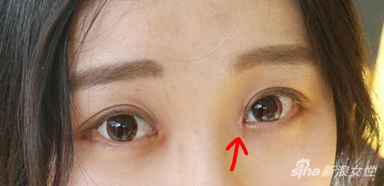 埋线双眼皮恢复30天过程图 LMRM-fxxhmcp4461157.jpg