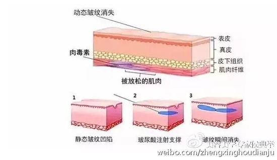 迅速祛皱