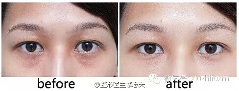 泪沟治疗前后的效果