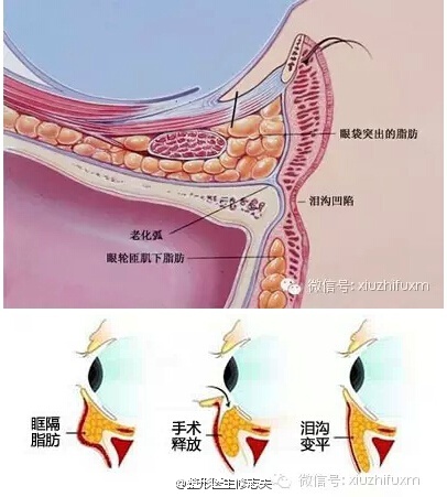 一下,看你是否需要填平这道沟!|泪沟|玻尿酸|眼袋