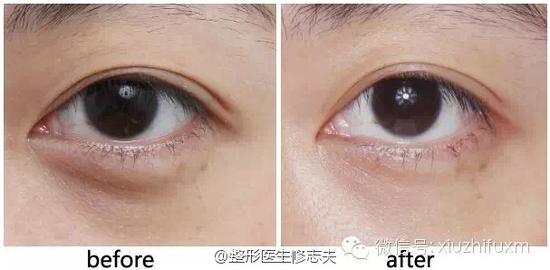 泪沟治疗前后的效果