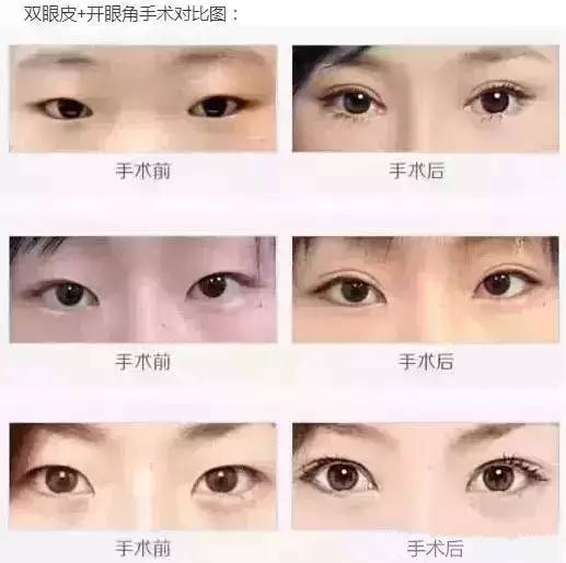 双眼皮+开眼角手术对比图