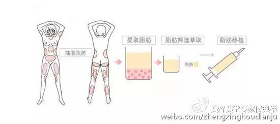 自体脂肪面部填充