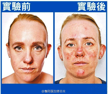 不卸妆实验的皮肤变化对比