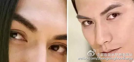 双眼皮