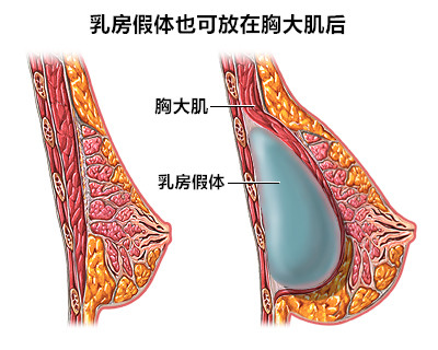 假体植入位置位于胸大肌后