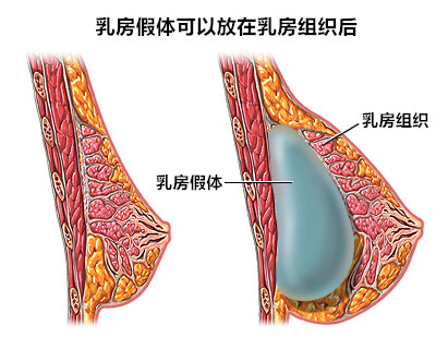 假体植入位置位于乳腺后