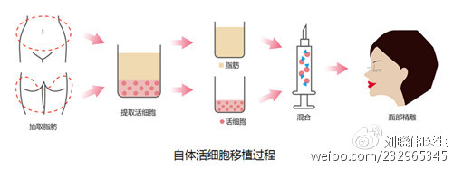 自体活细胞移植过程