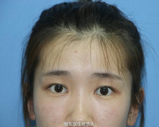 内双变外双,就是这么轻松|双眼皮|内双|外双