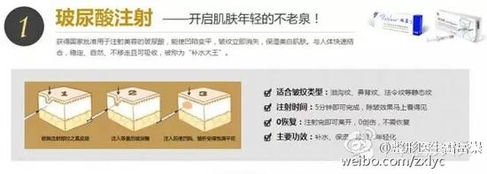 玻尿酸注射