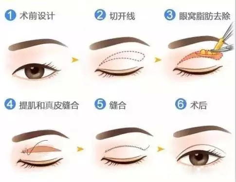 全切双眼皮 【科普篇】|双眼皮|手术|皮肤