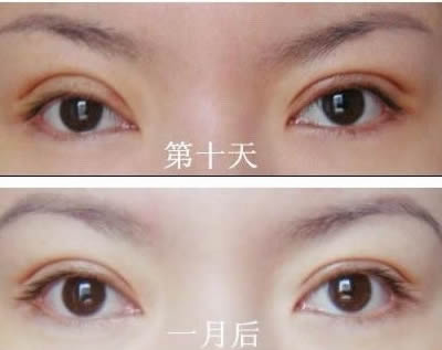 全切双眼皮