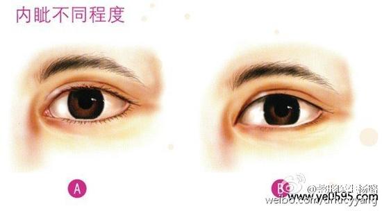 为什么要进行内眼角开大手术呢?|内眼角|内眦赘