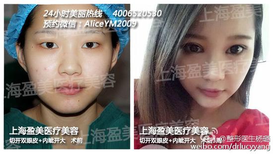 为什么要进行内眼角开大手术呢?|内眼角|内眦赘