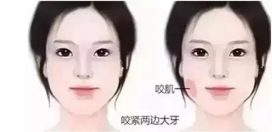 瘦脸针要怎么打,才能瘦得快美的久?|瘦脸针|医